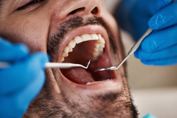 Best Knocked-Out Tooth (Avulsed Tooth) Treatment in Ewa Beach, HI